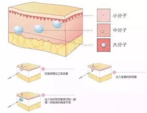 美容注射玻尿酸副作用，如何避免美容注射玻尿酸副作用，美容注射玻尿酸价格