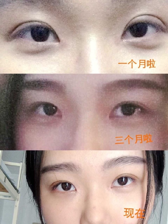 深圳美莱林登文全切双眼皮+开内眼角价格:7168 案例图