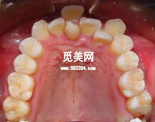 洗牙的好处和坏处是什么?干净洁白的牙齿不仅是口腔健康的标志,还能在一定程度上改善一个人的面部表情。