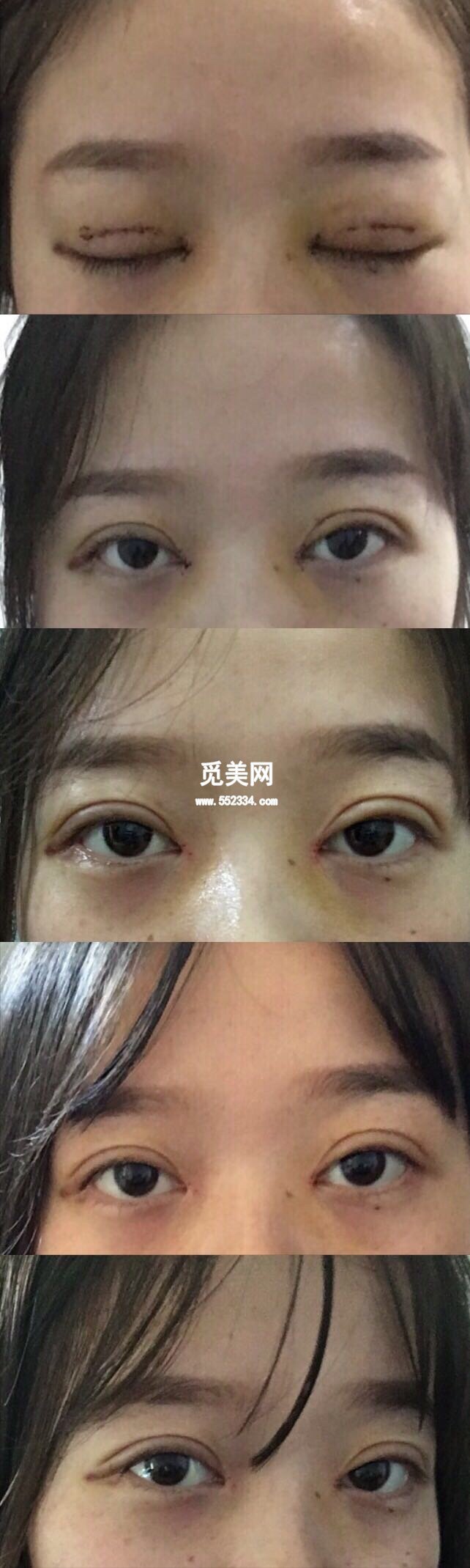 11月24日在武汉中爱祁向峰教授处做的微创双眼皮加开眼角开的7.5mm扇形 案例图分享