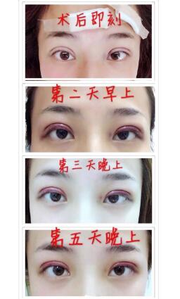 重庆星宸医院做韩式三点双眼皮+去脂案例图 价格:三千多 王振荣主任医术杠杠的