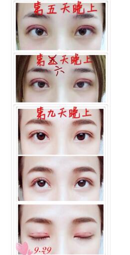 重庆星宸医院做韩式三点双眼皮+去脂案例图 价格:三千多 王振荣主任医术杠杠的