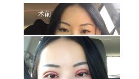 赣州韩美医院双眼皮修复案例 谢靓花医生技术口碑怎么样?好吗?