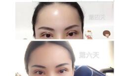 赣州韩美医院双眼皮修复案例 谢靓花医生技术口碑怎么样?好吗?