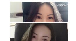 赣州韩美医院双眼皮修复案例 谢靓花医生技术口碑怎么样?好吗?