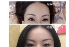 赣州韩美医院双眼皮修复案例 谢靓花医生技术口碑怎么样?好吗?