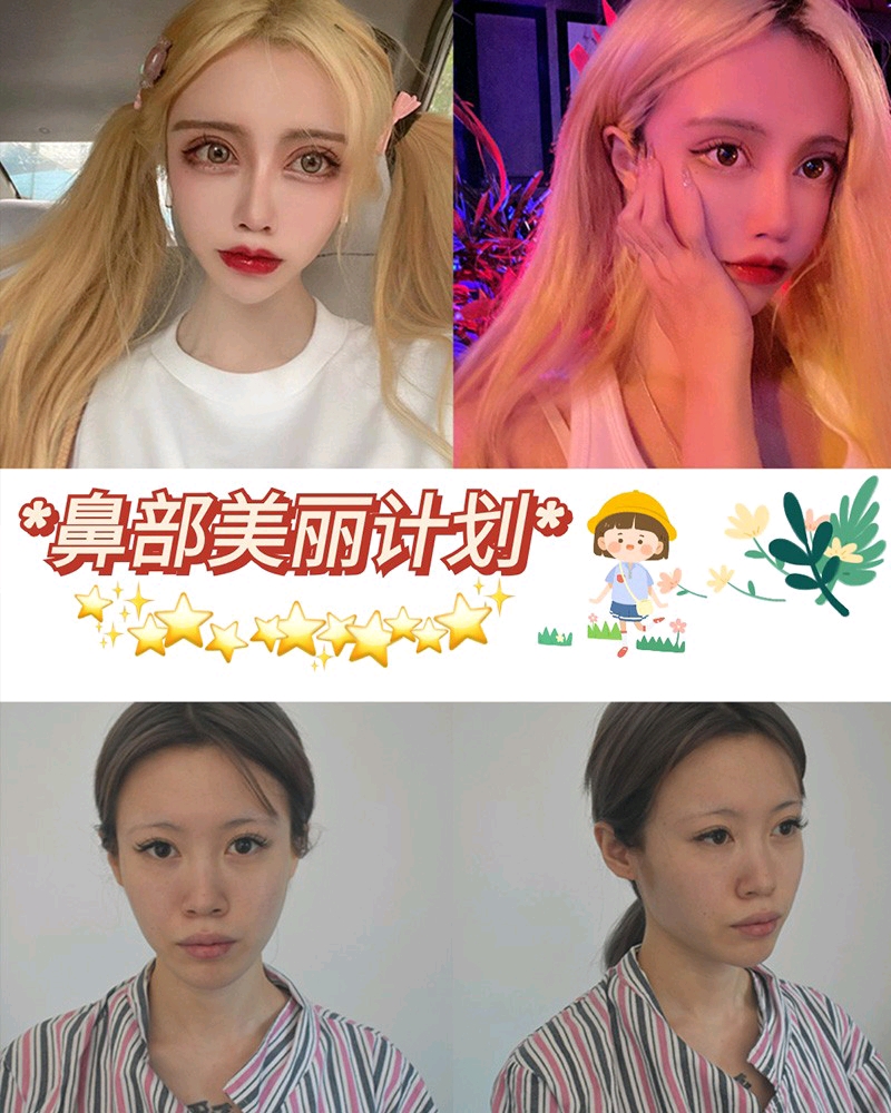 鼻头大，鼻翼宽，鼻子不秀气，鼻梁低平，缺少少女感 定制综合隆鼻改变了我