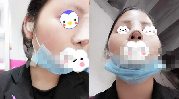 深圳蒳美迩整形医院隆鼻案例图分享 朱灿技术怎么样?口碑好吗?
