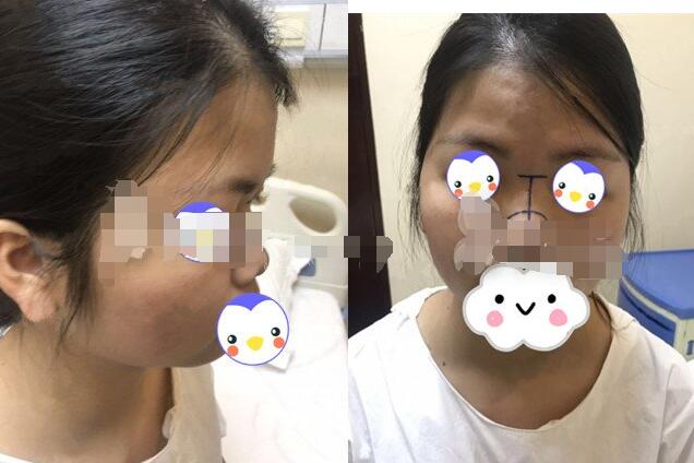 深圳蒳美迩整形医院隆鼻案例图分享 朱灿技术怎么样?口碑好吗?