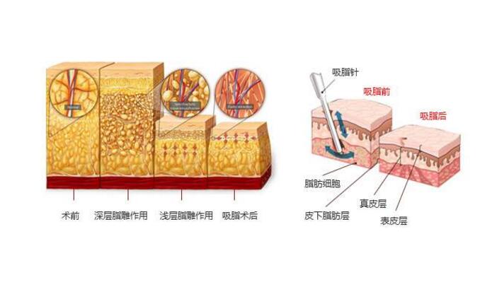 吸脂注意事项手术的特点有哪些