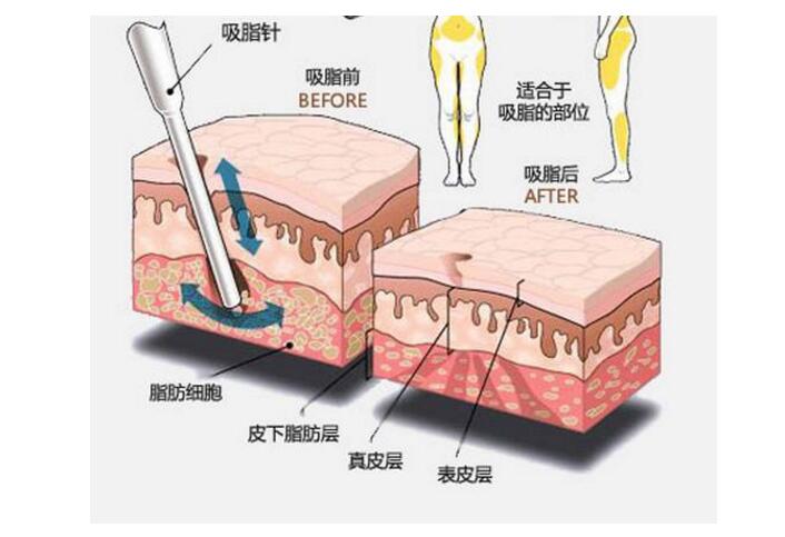 吸脂注意事项手术的特点有哪些