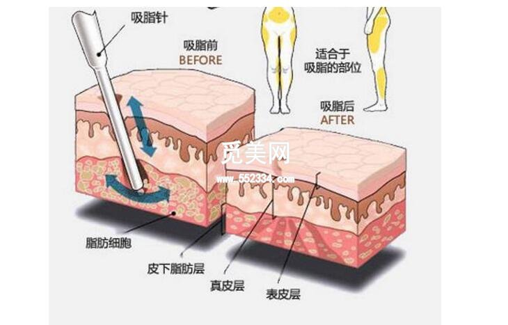 胳膊吸脂价格是多少钱？影响价格的因素有哪些？