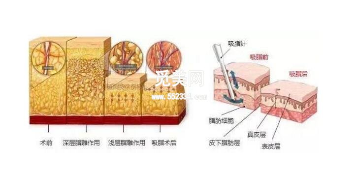 胳膊吸脂价格是多少钱？影响价格的因素有哪些？