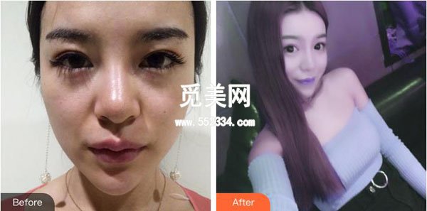 超声波去眼袋没问题吗?