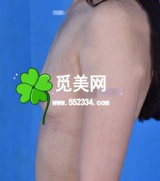 重庆五洲女子医院隆胸范文亮技术怎么样？手术案例图分享