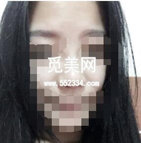 深圳艾妍徐荣阳做的综合隆鼻技术怎么样？案例*果图好看吗？