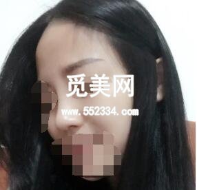 深圳艾妍徐荣阳做的综合隆鼻技术怎么样？案例*果图好看吗？