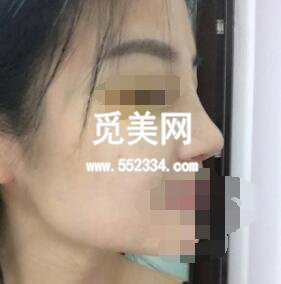 深圳艾妍徐荣阳做的综合隆鼻技术怎么样？案例*果图好看吗？