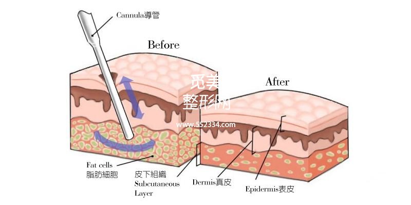 面部抽脂跟激光溶脂哪个果好？