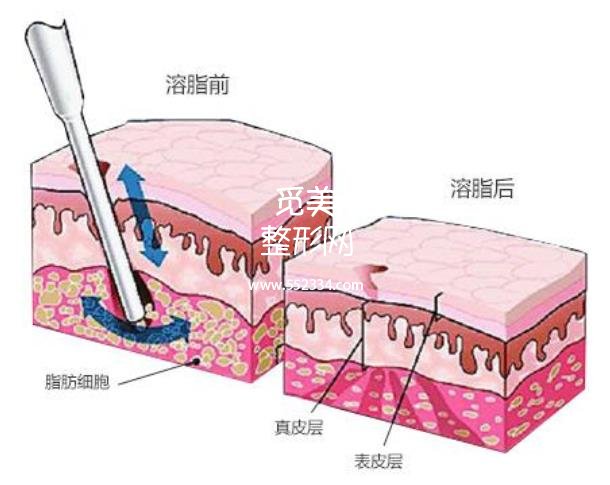 激光溶脂要打麻醉么？