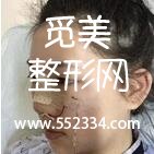 北京五洲女子医院整形于海峰医生隆鼻技术过硬 自信爆棚拍照不愁