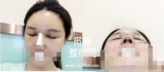 天津维美医院做综合隆鼻术案例图 鼻子变得的好看了附有图片