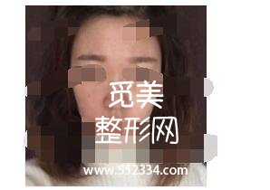 北京亚韩医院做隆鼻案例 鼻子挺起来了附有照片