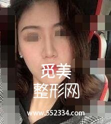 温州艺星美容医院硅胶隆鼻案例 塌鼻变俏鼻