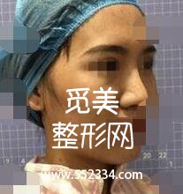 温州艺星美容医院硅胶隆鼻案例 塌鼻变俏鼻