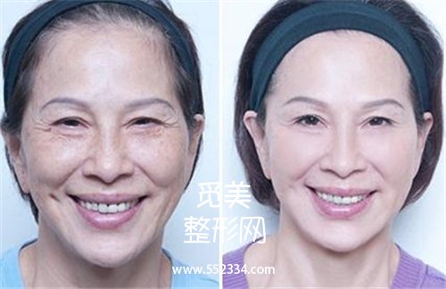 面部大拉皮除皱果怎么样?与哪些因素有关?