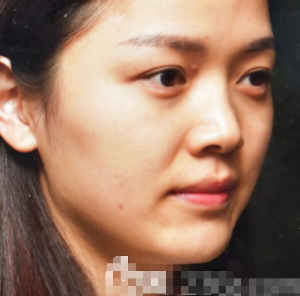我找深圳美莱梁晓健给我做了肋骨隆鼻修复手术(图)