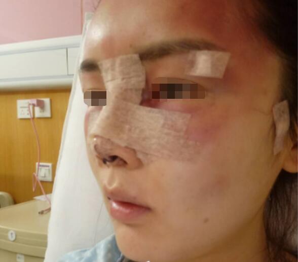 我找深圳美莱梁晓健给我做了肋骨隆鼻修复手术(图)