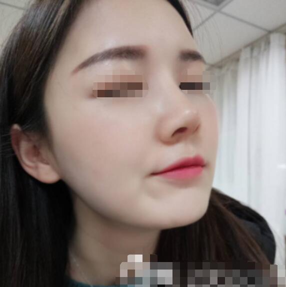 我找深圳美莱梁晓健给我做了肋骨隆鼻修复手术(图)