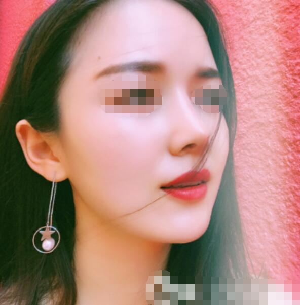我找深圳美莱梁晓健给我做了肋骨隆鼻修复手术(图)