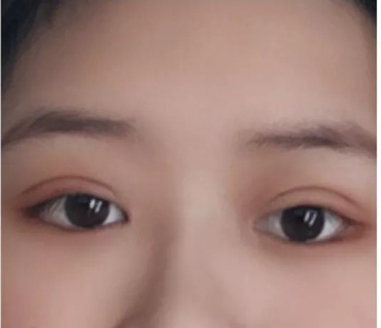 深圳人民医院双眼皮案例，术后颜值更加可爱叻！