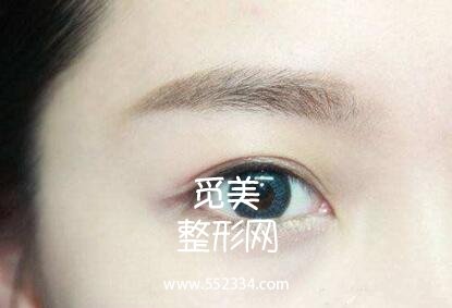 韩式三点式好吗?简单概括一下韩式三点双眼皮的优势!