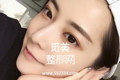 韩式三点式好吗?简单概括一下韩式三点双眼皮的优势!