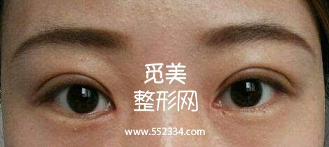 韩式三点式好吗?简单概括一下韩式三点双眼皮的优势!