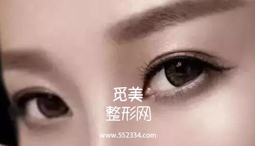 韩式三点式好吗?简单概括一下韩式三点双眼皮的优势!