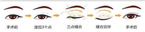 韩式三点式好吗?简单概括一下韩式三点双眼皮的优势!