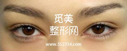 韩式三点式好吗?简单概括一下韩式三点双眼皮的优势!