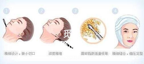 面颊部吸脂手术*吗?容易反弹吗?