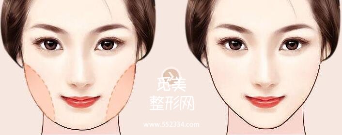 面颊部吸脂手术*吗?容易反弹吗?