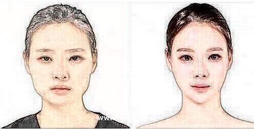 面颊部吸脂手术*吗?容易反弹吗?
