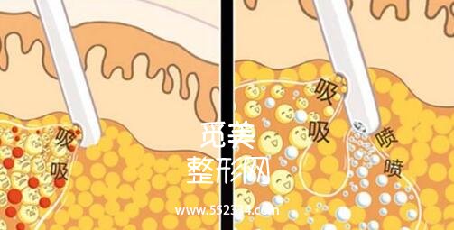 面颊部吸脂手术*吗?容易反弹吗?