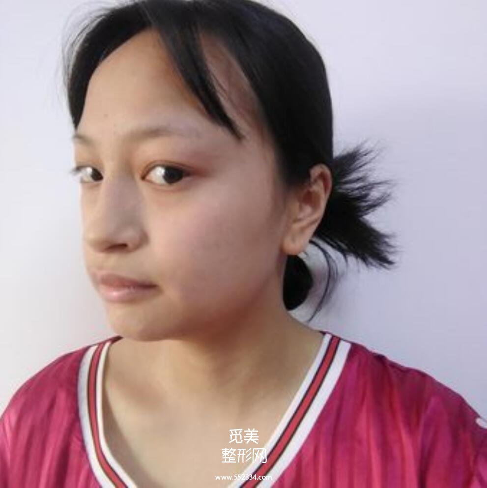 北京大学深圳医院整形科隆鼻价格及恢复真实案例分享