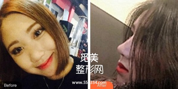 南昌同济医院做隆鼻怎么样?价格表及真人案例图分享