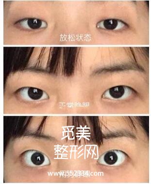 江苏省中医院整形科刘宁割双眼皮+开内眼角案例图分享