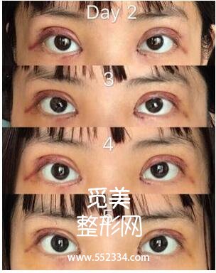 江苏省中医院整形科刘宁割双眼皮+开内眼角案例图分享
