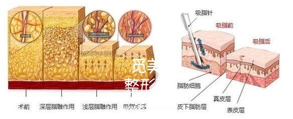深圳博美王红玮吸脂的技术技术怎么样?案例图分享